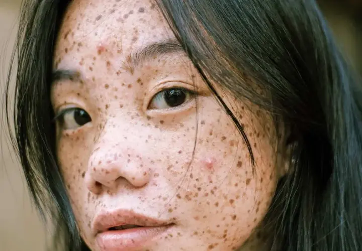 Primer plano de una joven con pecas y una mancha abultada en la cara, con cabello oscuro cayendo sobre su rostro.