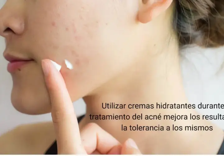Una persona aplica crema hidratante en su rostro con acné. Es bueno echarse crema hidratante en los granos para mejorar el tratamiento.