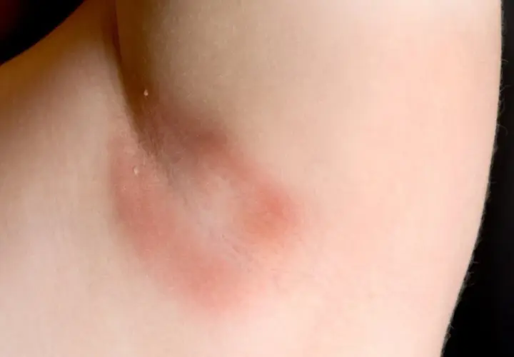 Axila con piel enrojecida y engrosada, indicativo de acantosis nigricans. El tratamiento busca mejorar la apariencia y salud de la piel.