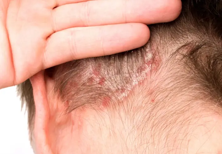 Primer plano de un cuero cabelludo con escamas blancas y enrojecimiento, indicativo de enfermedades del cuero cabelludo.