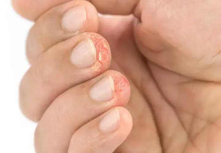 Dedos con piel agrietada y enrojecida, síntoma de dishidrosis mano.