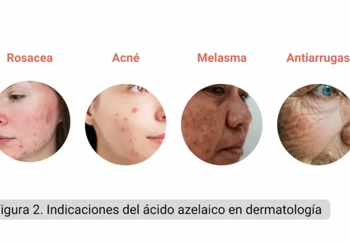 El ácido azelaico sirve para tratar rosácea, acné, melasma y arrugas. Muestra rostros con estas afecciones.