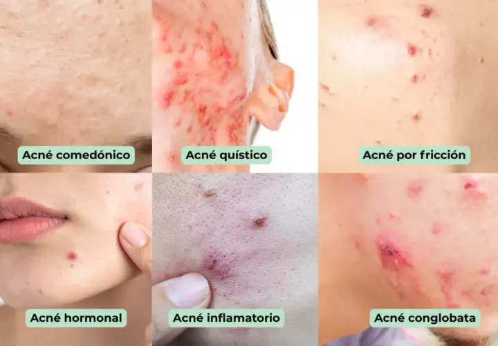 Seis imágenes muestran diferentes tipos de acné: comedónico, quístico, por fricción, hormonal, inflamatorio y<bos> conlobata.