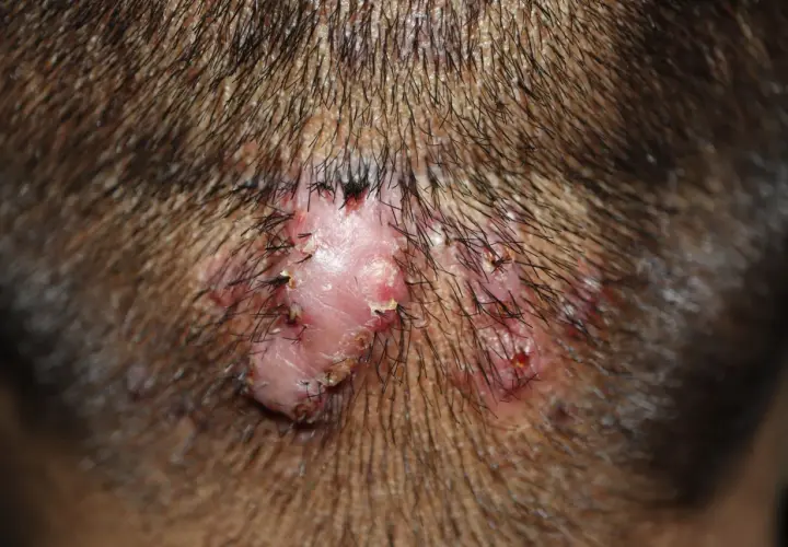 Lesión cutánea con varios granos en el cuello, rodeada de vello oscuro.