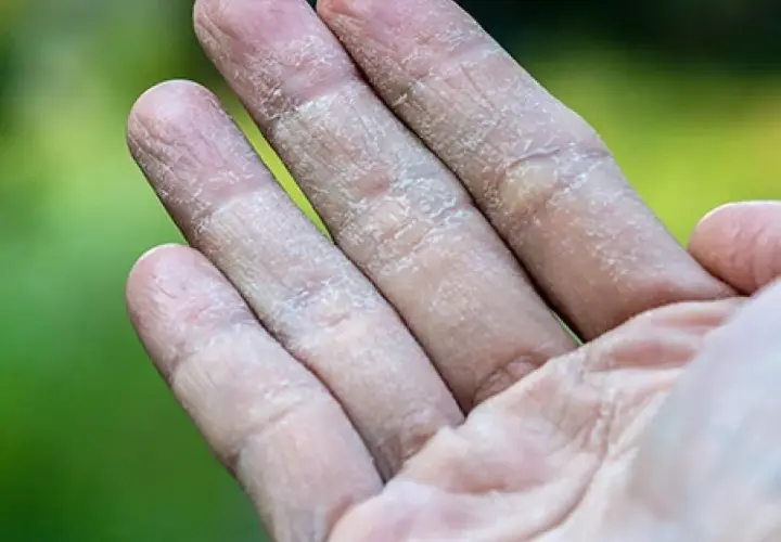 Dedos con piel seca y agrietada, mostrando síntomas de eccema dishidrótico.