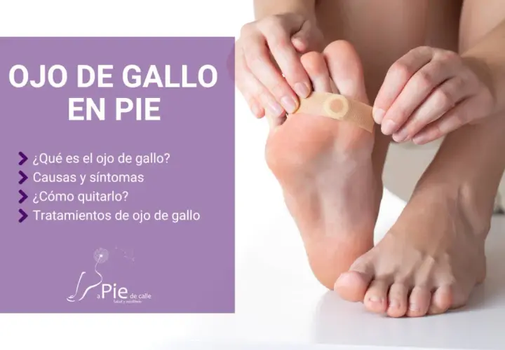 Persona aplica un parche para tratar un ojo de gallo en el pie. El texto indica "Ojo de gallo en pie" y ofrece información sobre causas, síntomas y tratamientos.