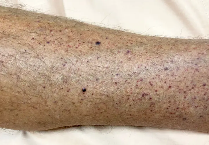 Primer plano de la piel de una pierna con numerosos puntos rojos y morados, mostrando diferentes tipos de manchas en las piernas.