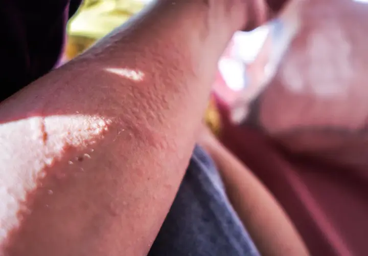 Brazo con erupción cutánea y ampollas, indicando una posible reaccion alergica al sol.
