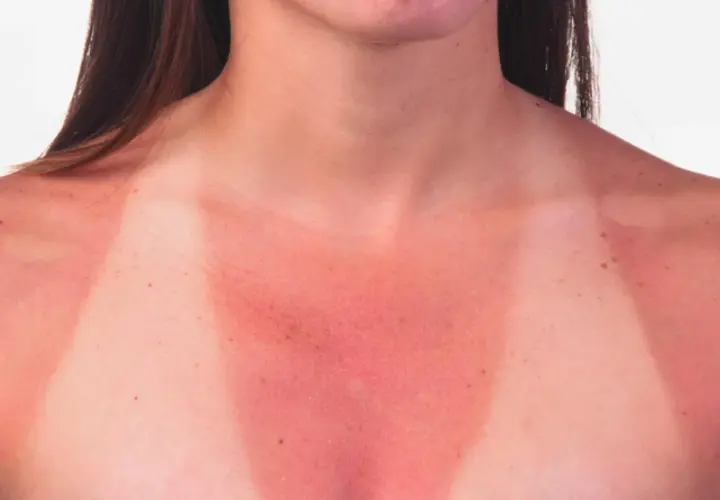 Piel enrojecida y quemada por el sol en el pecho y hombros, mostrando el resultado de qué pasa si te echas crema solar caducada.