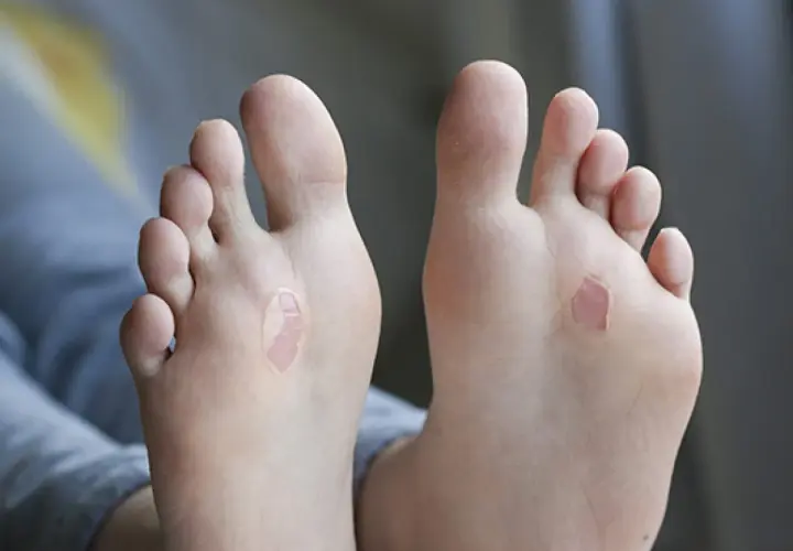 Pies con ampollas de sangre, resultado de una larga caminata.