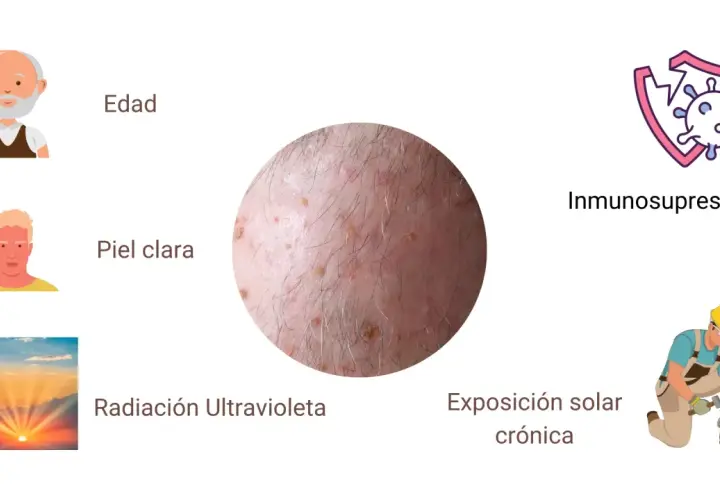 Lesiones en la piel que sugieren queratosis actínica, asociadas a edad, piel clara, radiación UV e inmunosupresión.