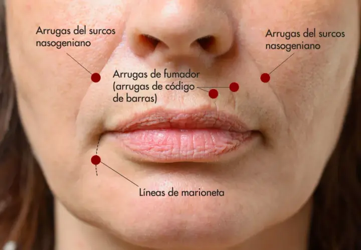 Primer plano de un rostro femenino mostrando arrugas del surco nasogeniano, líneas de marioneta y arrugas de fumador.