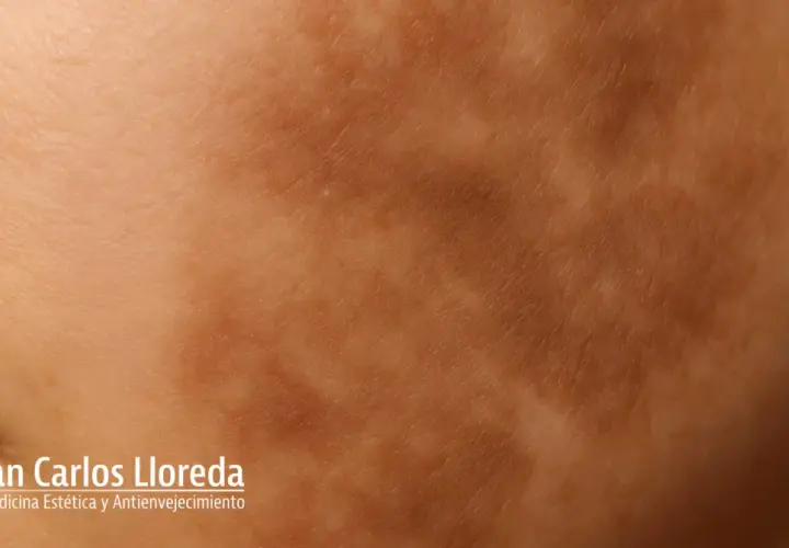 Piel con hiperpigmentación postinflamatoria, mostrando manchas oscuras y textura irregular. Logo de Dr. Juan Carlos Lloreda.