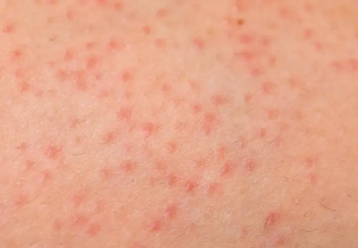 Piel con pequeñas protuberancias rojas y ásperas, indicativo de queratosis pilaris.