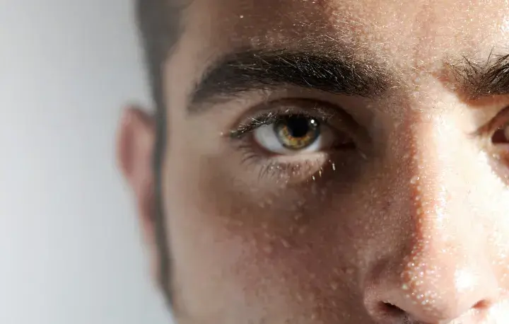 Ojos y frente de un hombre con gotas de sudor visibles, evidencia de hiperhidrosis facial.