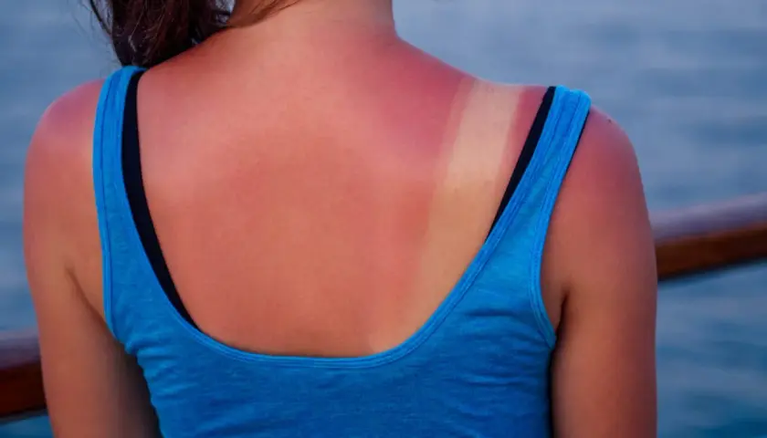 Espalda con piel quemada por el sol, mostrando un bronceado desigual y enrojecimiento.