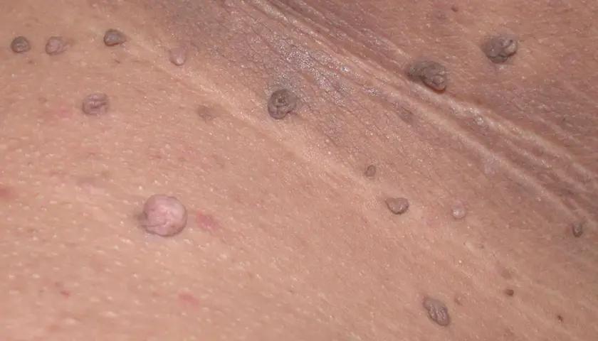 Primer plano de verrugas en las axilas, algunas de ellas con aspecto carnoso y otras más pequeñas y oscuras.