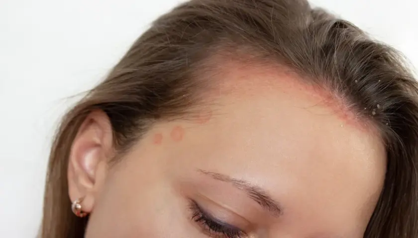 Piel enrojecida y escamosa en la frente y línea del cabello, con anillos rojos en la sien. Posible dermatitis seborreica, buscando tratamiento.