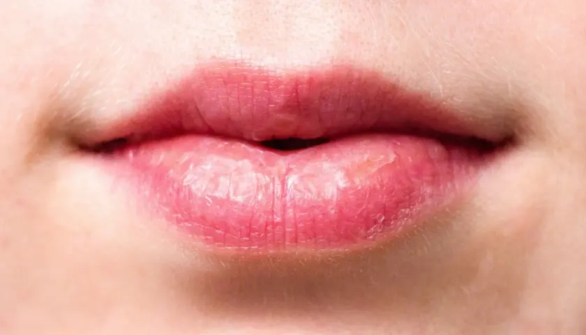 Labios rojos y agrietados, con aspecto de labios quemados por el sol, mostrando sequedad y descamación.