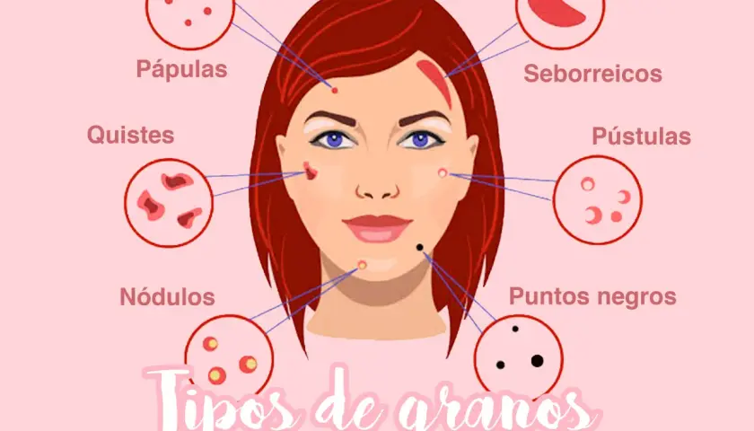 Ilustración que muestra diferentes tipos de granos en la cara: pápulas, quistes, nódulos, seborreicos, pústulas y puntos negros.