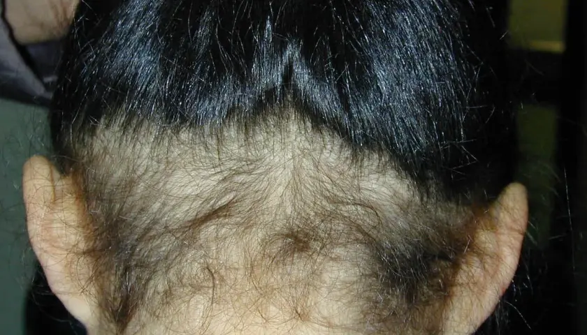 Vista posterior de una cabeza con cabello oscuro y lacio, mostrando una zona de poca densidad de pelo en la nuca y alrededor de las orejas.