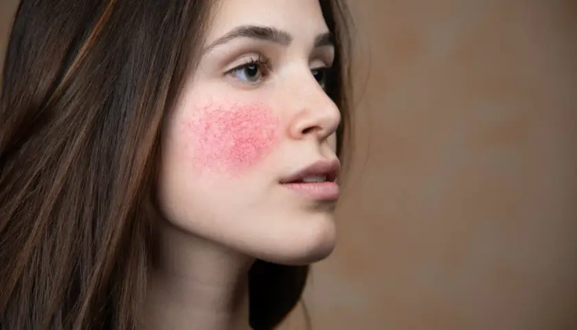 Mujer con rubor facial intenso y visible en las mejillas, mostrando la piel enrojecida y con pequeños vasos sanguíneos.