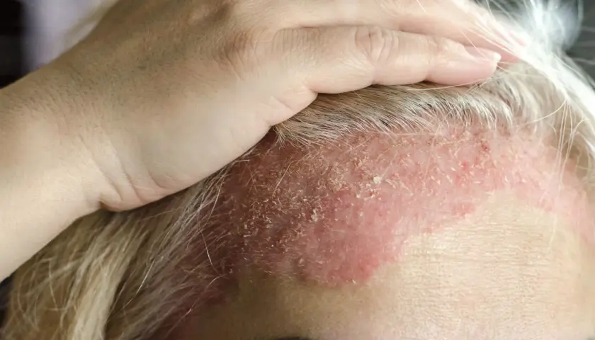 Una mano toca la frente de una mujer con dermatitis en la cara, mostrando piel enrojecida y escamosa.