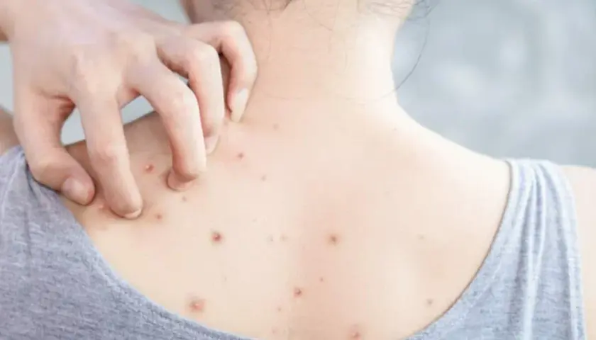 Una persona se rasca la espalda, mostrando varias espinillas gigantes que le causan picazón.