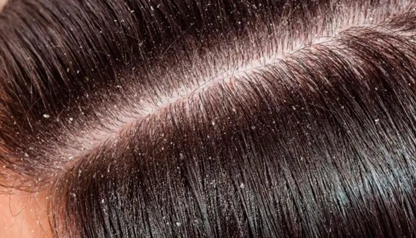 Primer plano del cuero cabelludo con cabello oscuro y escamas blancas, indicando varios tipos de caspa en la cabeza.