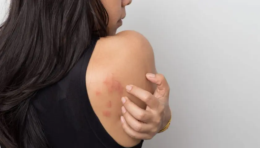 Mujer se rasca el hombro, mostrando ronchas rojas en la piel que pican.