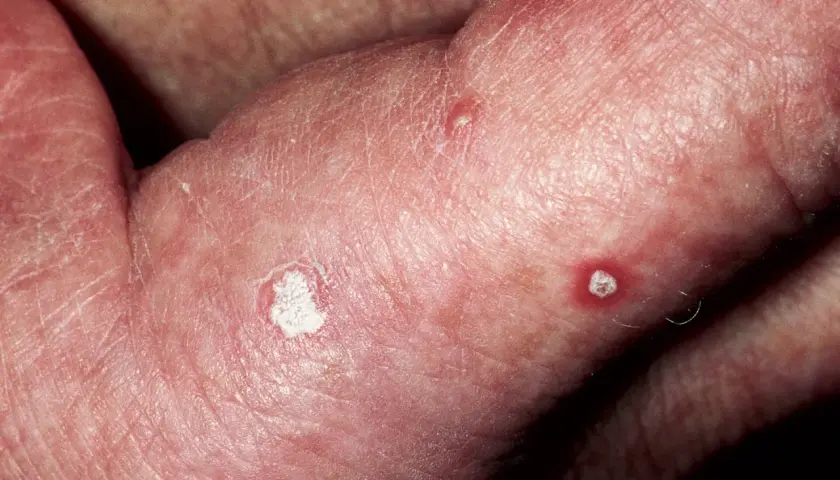 Piel enrojecida con escamas blancas y pequeñas lesiones, indicativas de queratosis solar.