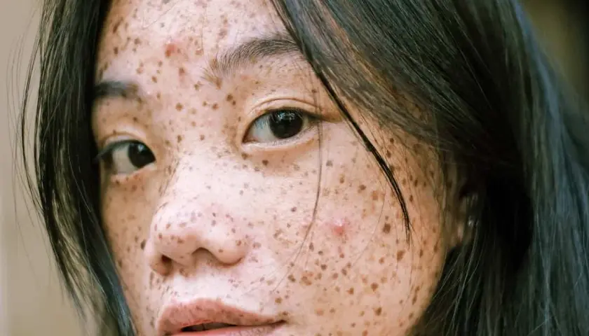 Primer plano de una joven con pecas y una mancha abultada en la cara, con cabello oscuro cayendo sobre su rostro.