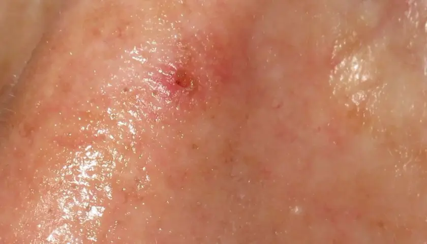Lesión cutánea en la nariz, posiblemente queratosis actínica, con enrojecimiento y descamación.
