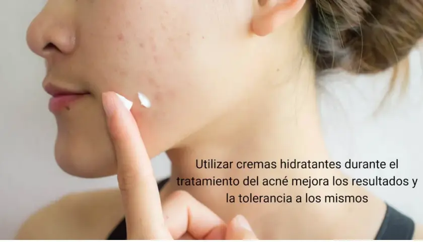 Una persona aplica crema hidratante en su rostro con acné. Es bueno echarse crema hidratante en los granos para mejorar el tratamiento.