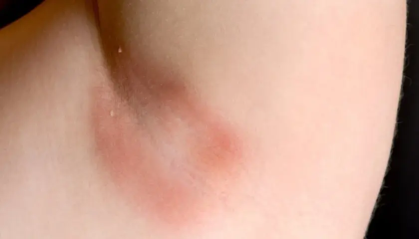 Axila con piel enrojecida y engrosada, indicativo de acantosis nigricans. El tratamiento busca mejorar la apariencia y salud de la piel.