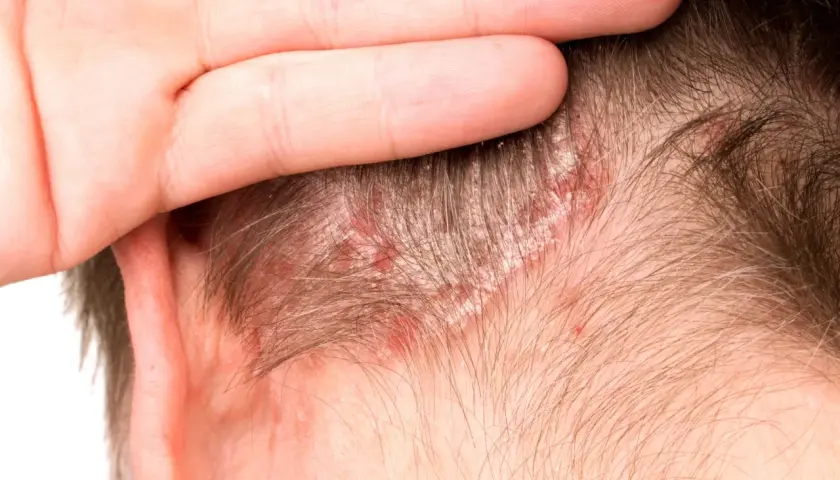 Primer plano de un cuero cabelludo con escamas blancas y enrojecimiento, indicativo de enfermedades del cuero cabelludo.