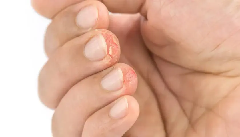 Dedos con piel agrietada y enrojecida, síntoma de dishidrosis mano.