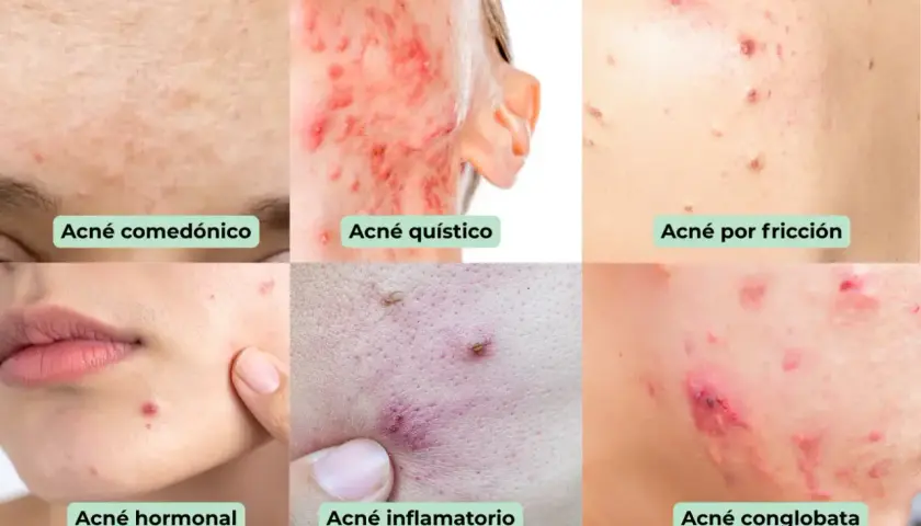Seis imágenes muestran diferentes tipos de acné: comedónico, quístico, por fricción, hormonal, inflamatorio y<bos> conlobata.