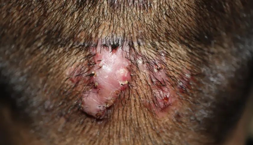 Lesión cutánea con varios granos en el cuello, rodeada de vello oscuro.