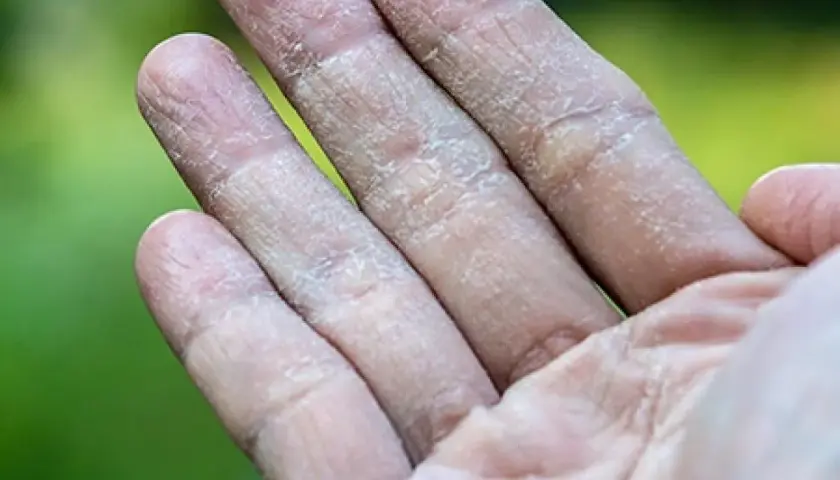 Dedos con piel seca y agrietada, mostrando síntomas de eccema dishidrótico.