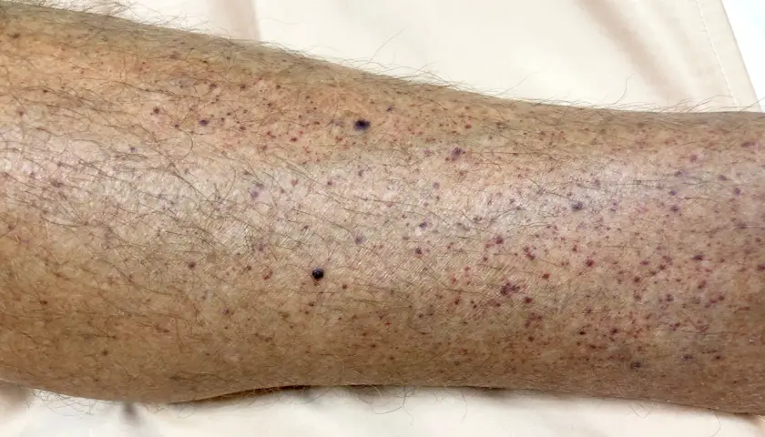 Primer plano de la piel de una pierna con numerosos puntos rojos y morados, mostrando diferentes tipos de manchas en las piernas.