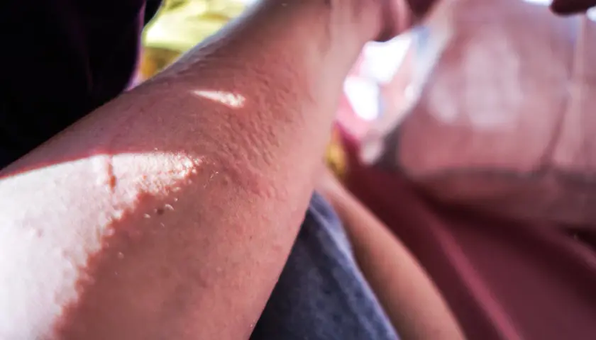 Brazo con erupción cutánea y ampollas, indicando una posible reaccion alergica al sol.