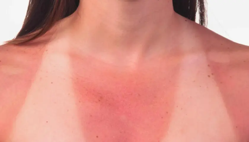 Piel enrojecida y quemada por el sol en el pecho y hombros, mostrando el resultado de qué pasa si te echas crema solar caducada.