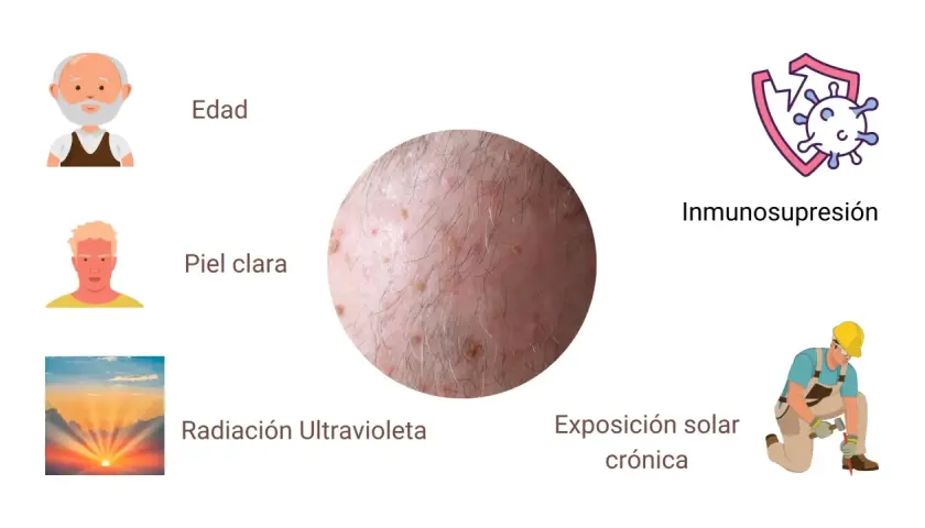 Lesiones en la piel que sugieren queratosis actínica, asociadas a edad, piel clara, radiación UV e inmunosupresión.