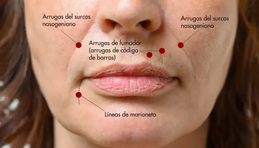 Primer plano de un rostro femenino mostrando arrugas del surco nasogeniano, líneas de marioneta y arrugas de fumador.