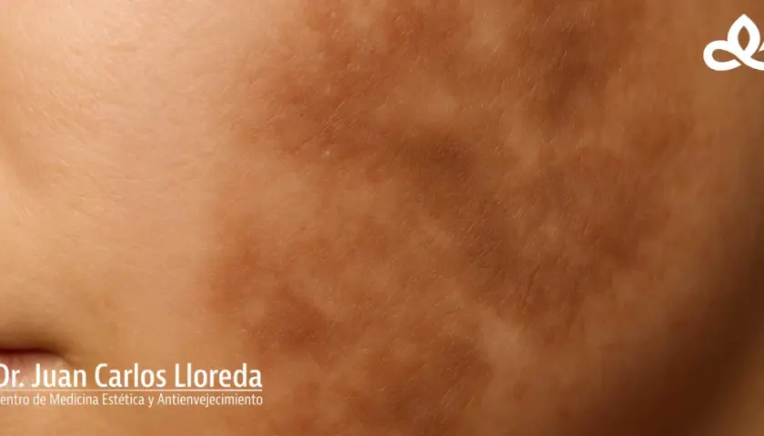 Piel con hiperpigmentación postinflamatoria, mostrando manchas oscuras y textura irregular. Logo de Dr. Juan Carlos Lloreda.