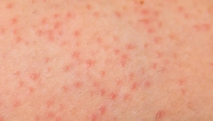 Piel con pequeñas protuberancias rojas y ásperas, indicativo de queratosis pilaris.