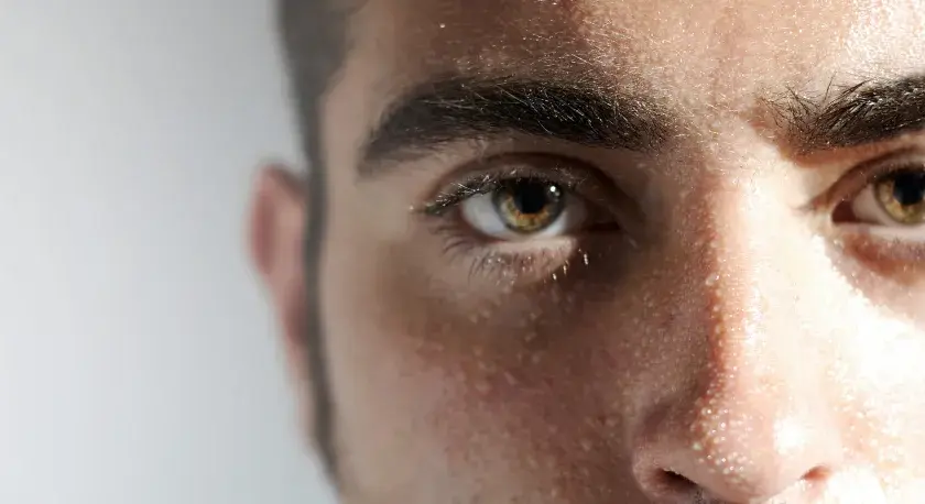 Ojos y frente de un hombre con gotas de sudor visibles, evidencia de hiperhidrosis facial.