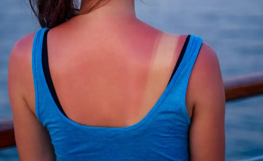 Qué hacer tras una quemadura solar y cuándo consultar