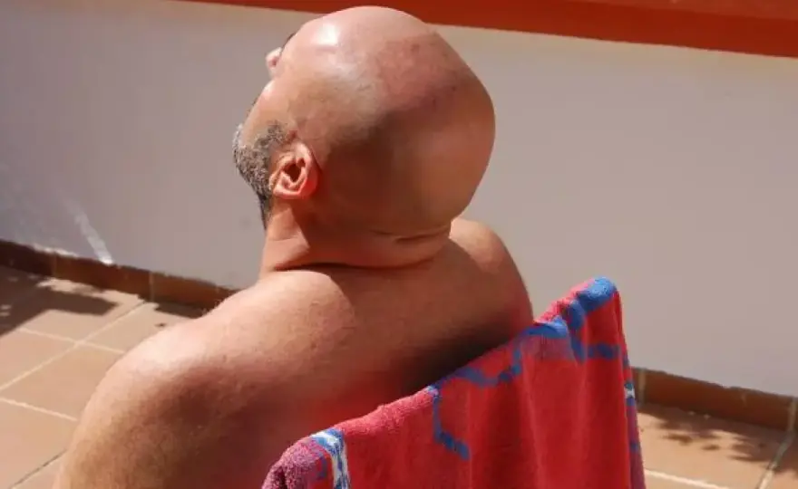 Cuero cabelludo quemado por el sol - qué hacer y cuándo consultar